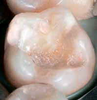 Ecusphere Carat - начальная полость